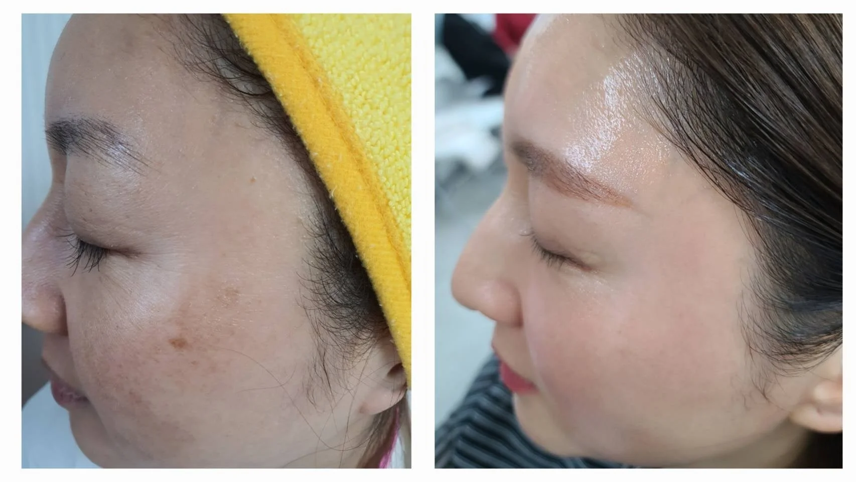 スキンケアによる肌改善のビフォーアフター