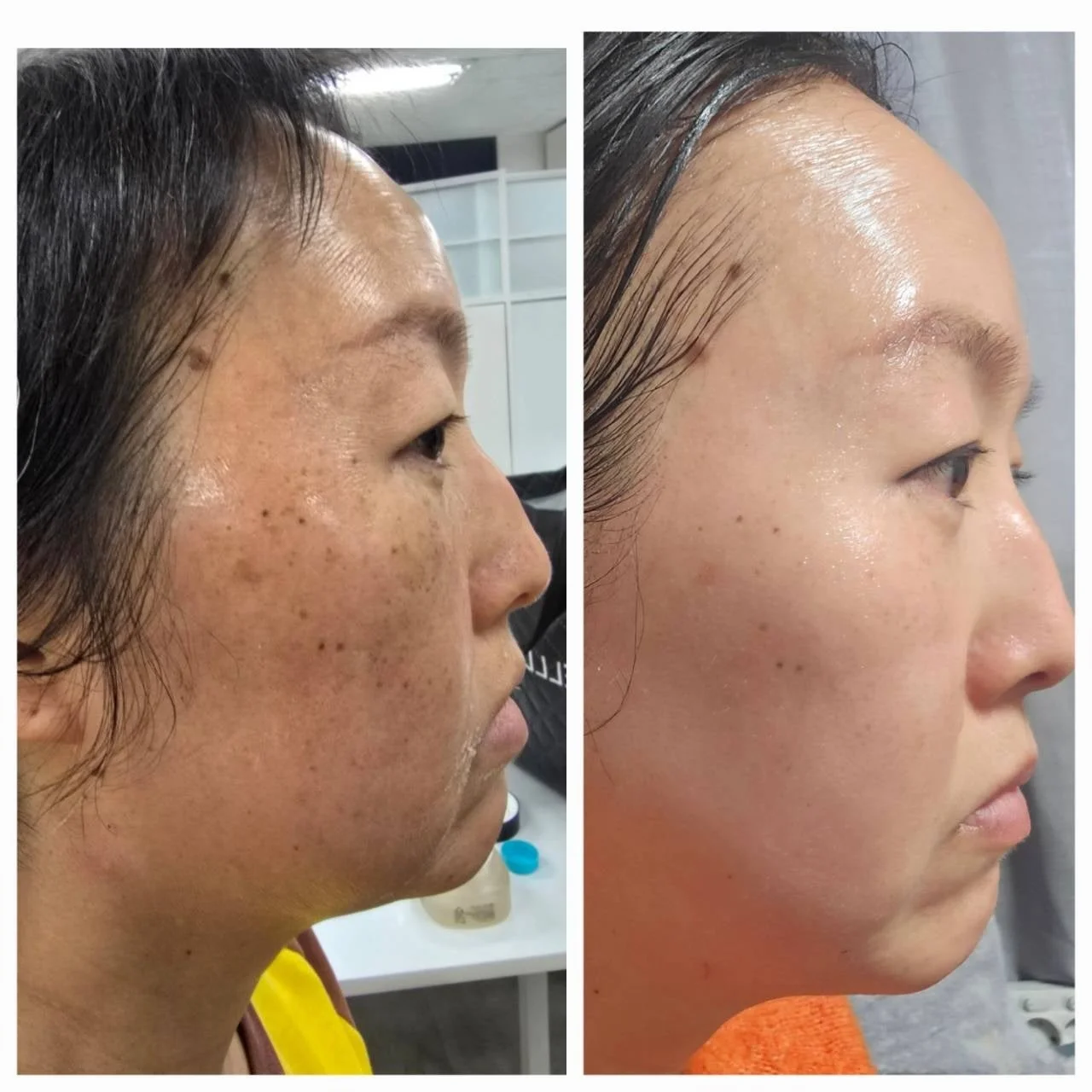 肌治療のビフォーアフター